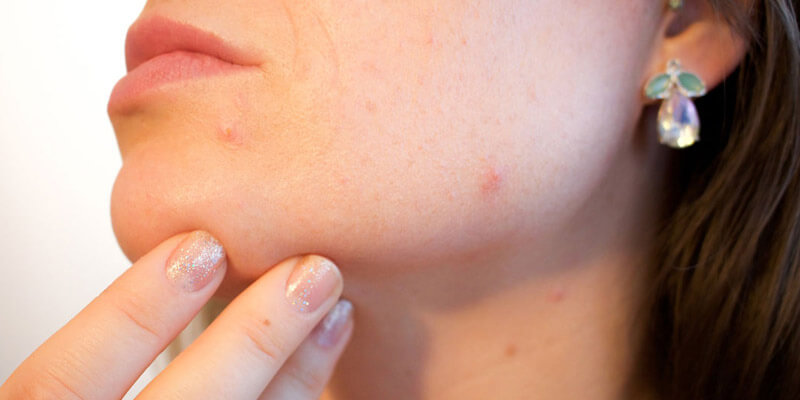 Acne Scars are caused by acne vulgaris