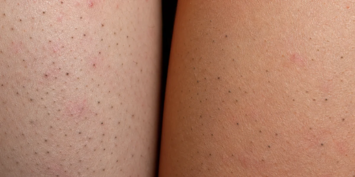 Close-up of skin with blackheads on legs and arms, showing small dark pores