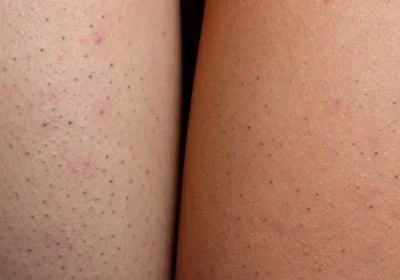 Close-up of skin with blackheads on legs and arms, showing small dark pores